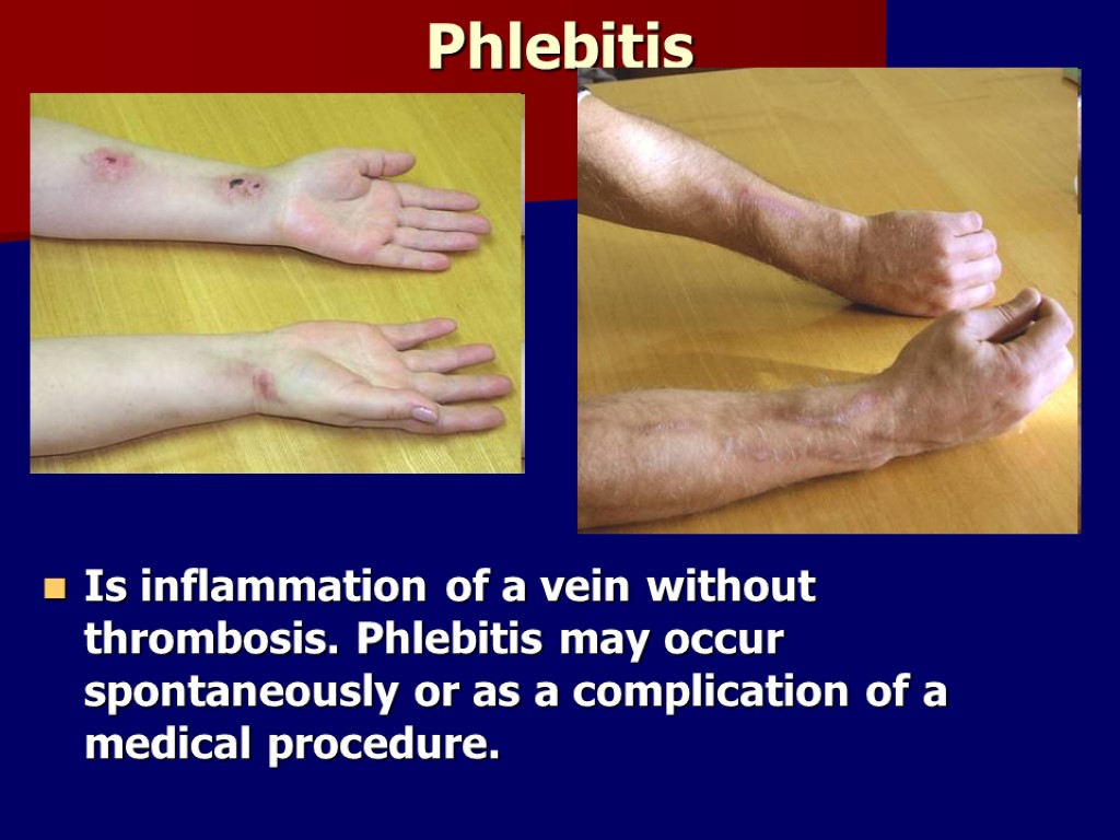 Phlebitis Is inflammation of a vein without thrombosis. Phlebitis may occur spontaneously or as